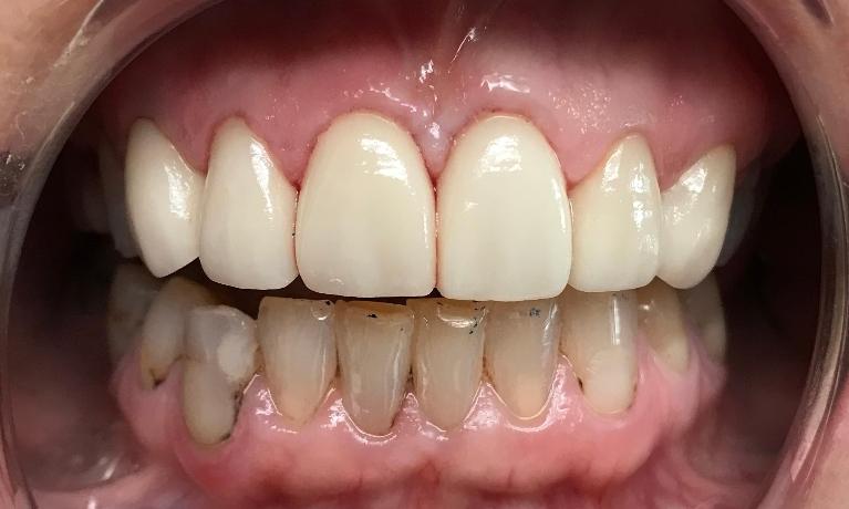 Ceramic-Crowns-After-Image