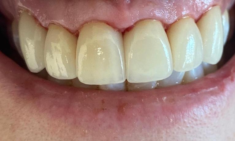 Ceramic-Veneers-After-Image