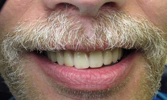 Dentures-After-Image
