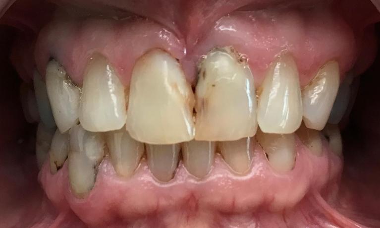 Ceramic-Crowns-Before-Image