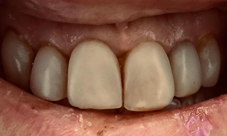 Ceramic-Veneers-Before-Image