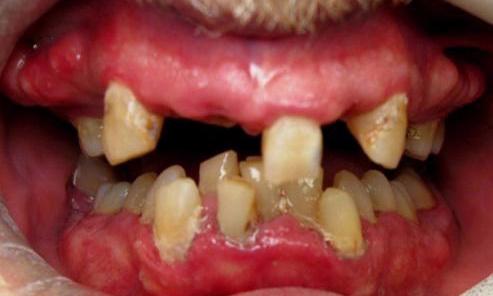 Dentures-Before-Image